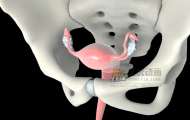 子宫手术-医学动画网站作品